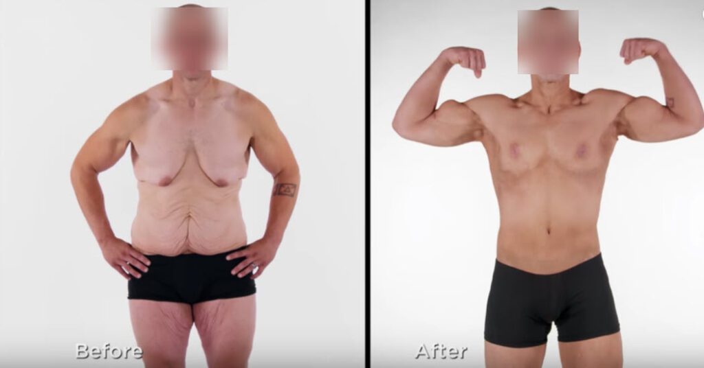 male skin removal surgery before after