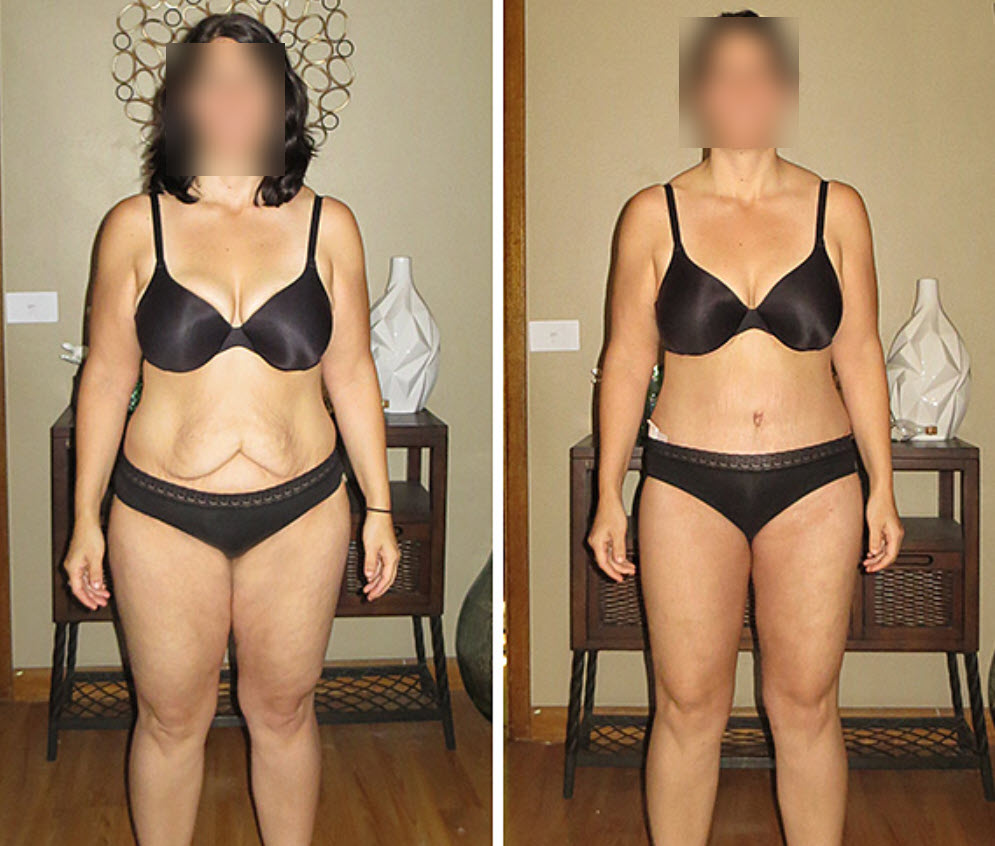 Loose Skin After Weight Loss: Post-Surgery Causes, and Solutions