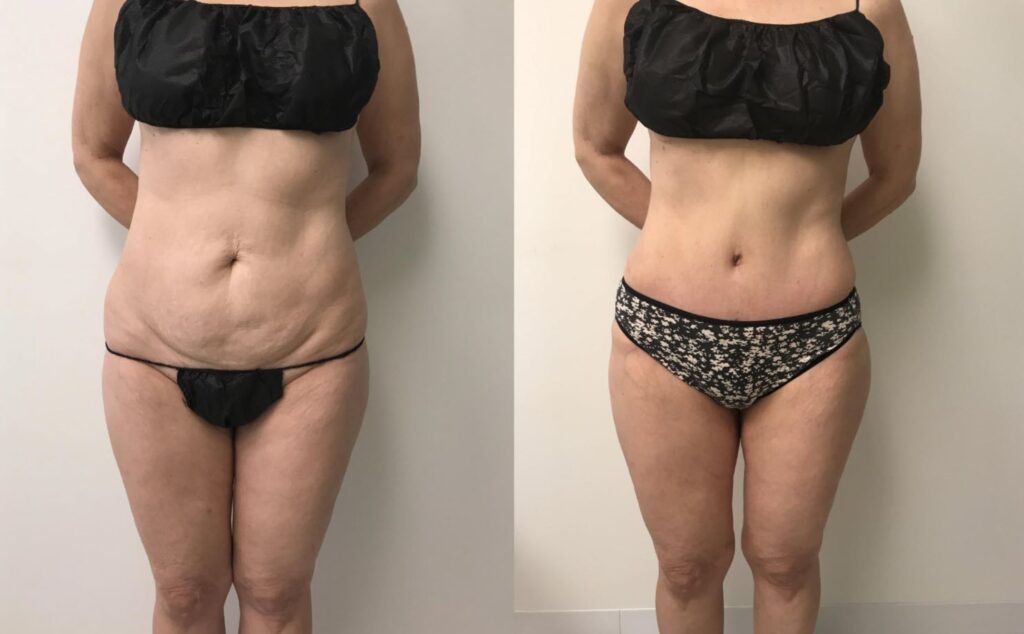 Skin Removal Surgery Cost & Common Questions Are You a Candidate?