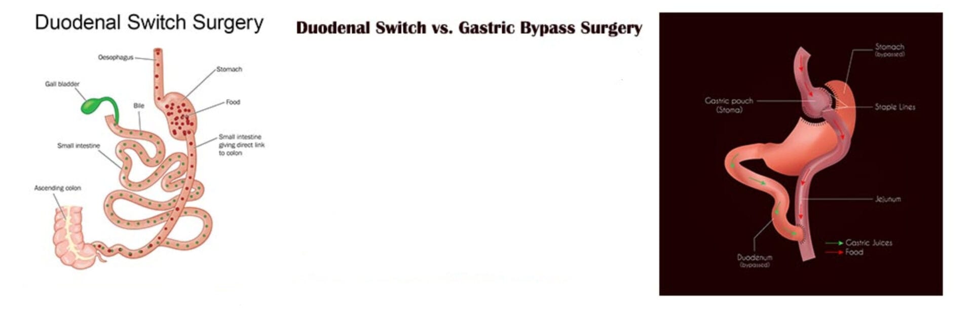 What is Duodenal Switch? VIDA Wellness and Beauty Tijuana