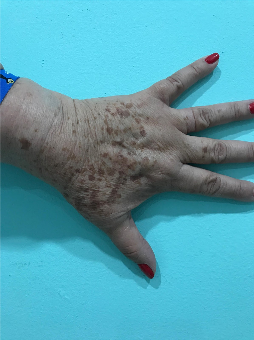 How to Use IPL for Melasma, Rosacea, Dark Spots &amp; More | VIDA