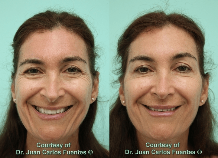 antes y despues botox