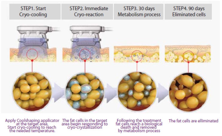 fat freezing-coolsculpting