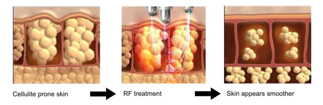 radio-frequency fat loss treatment