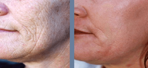 Full skin resurfacing with dermablate laser