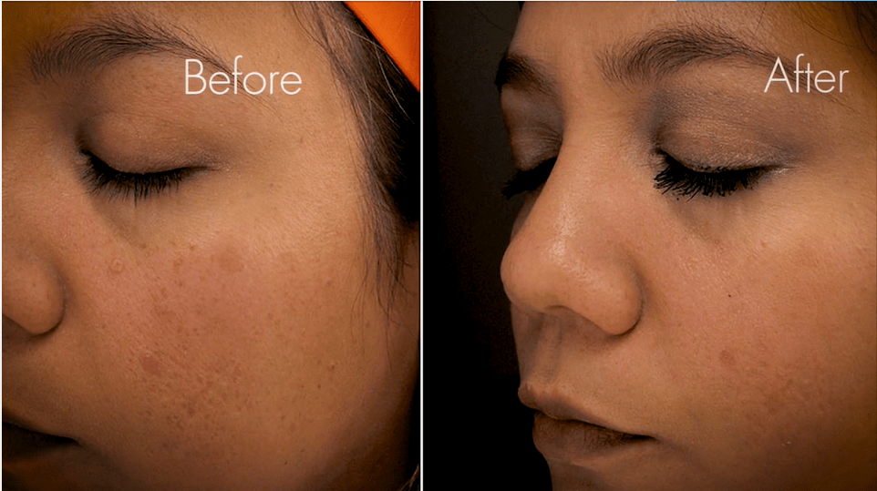 acne scars treated with laser