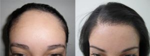 What is a Micro Hair Transplant? | VIDA Wellness and Beauty