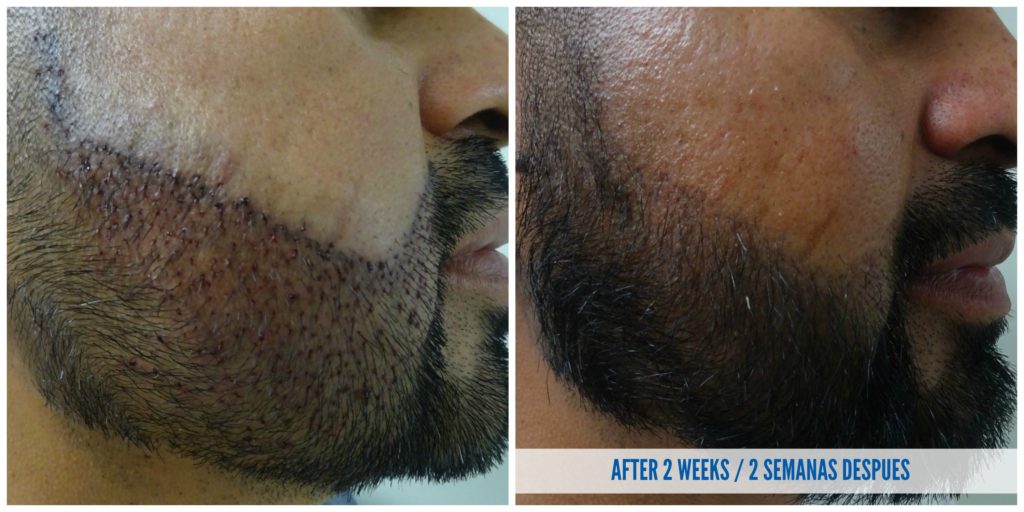 beard transplant in tijuana