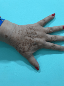 darkspots hand 