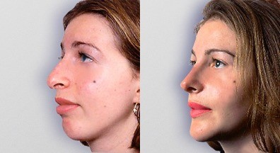 Chin and cheek implants and rhinoplasty before and after