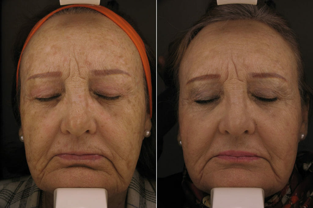 before and after laser resurfacing
