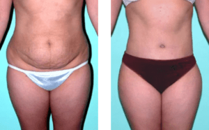 tummy tuck before and after