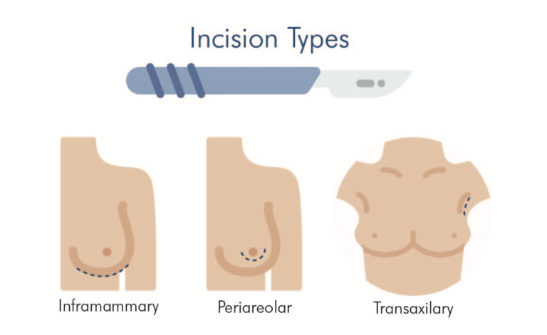 Gummy Bear Breast Implants, Anatomical Teardrop Shaped Breast