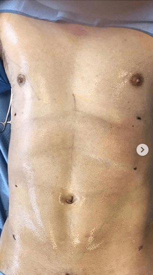 Abdominal Etching (Liposculpture) Surgery