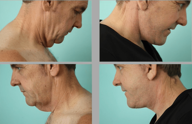 Before and after Necklift | Dr. Quiroz
