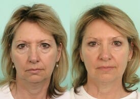 botox tijuana before and after