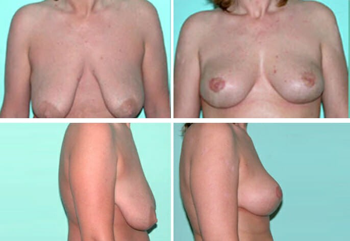 breast lift 