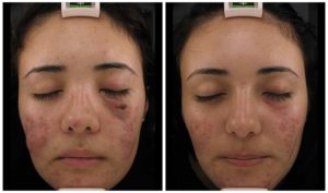 ipl clinical melasma spots dark dermatology vida acne rosacea use scars laser