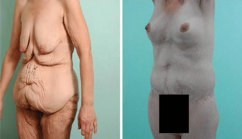body lift and breast lift