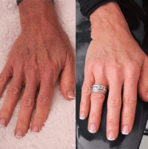 before and after hands fillers