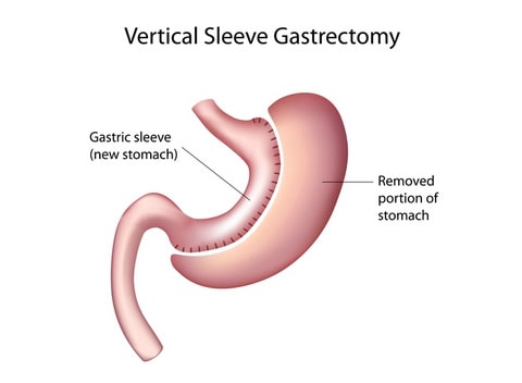 img-med-gastric-sleeve-resized