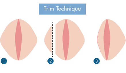 labiaplasty trim technique