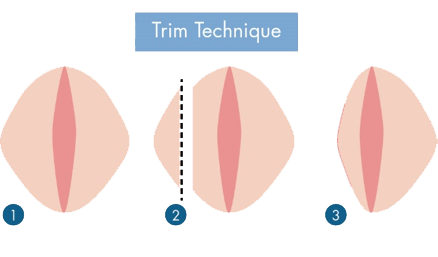 Monsplasty Vs. Labiaplasty: What Is the Difference and Who Can