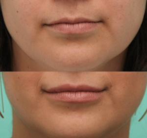lips fillers before and after