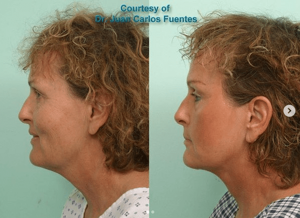 necklift before and after tijuana 