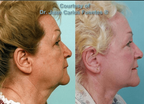neck lift before and after dr fuentes tijuana 