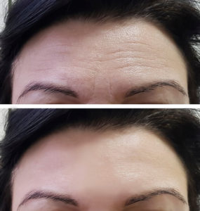 forehead botox before and after