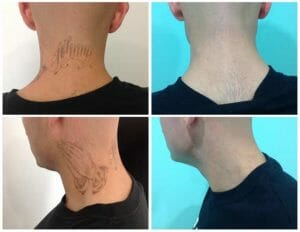 Laser Tattoo Removal San Diego | PICO Laser | MedDerm
