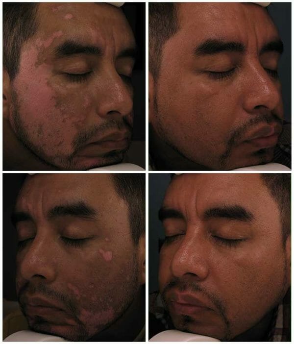 vitiligio treatment tijuana Dr. de la Fuente