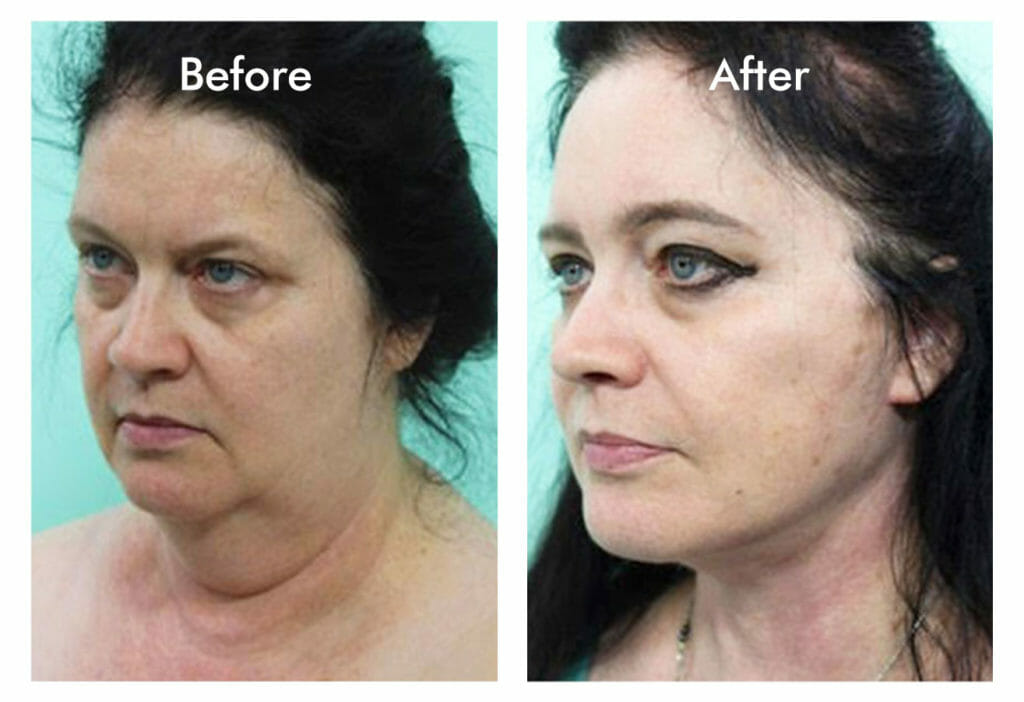 woman facelift