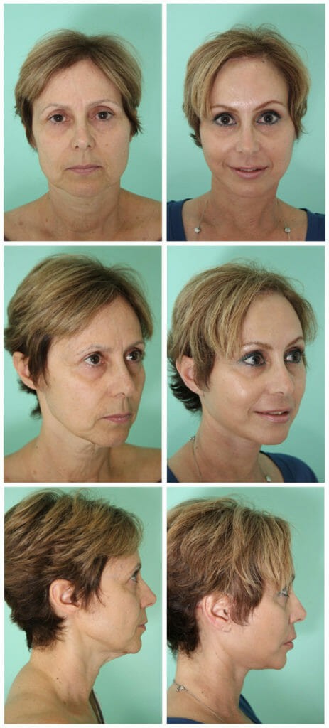 Facelift by Dr. Alejandro Quiroz Cosmed Tijuana