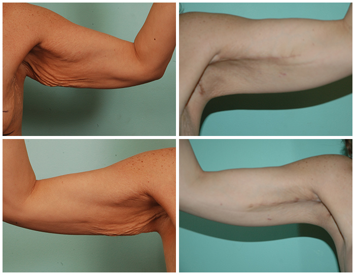 arm lift surgery before and after