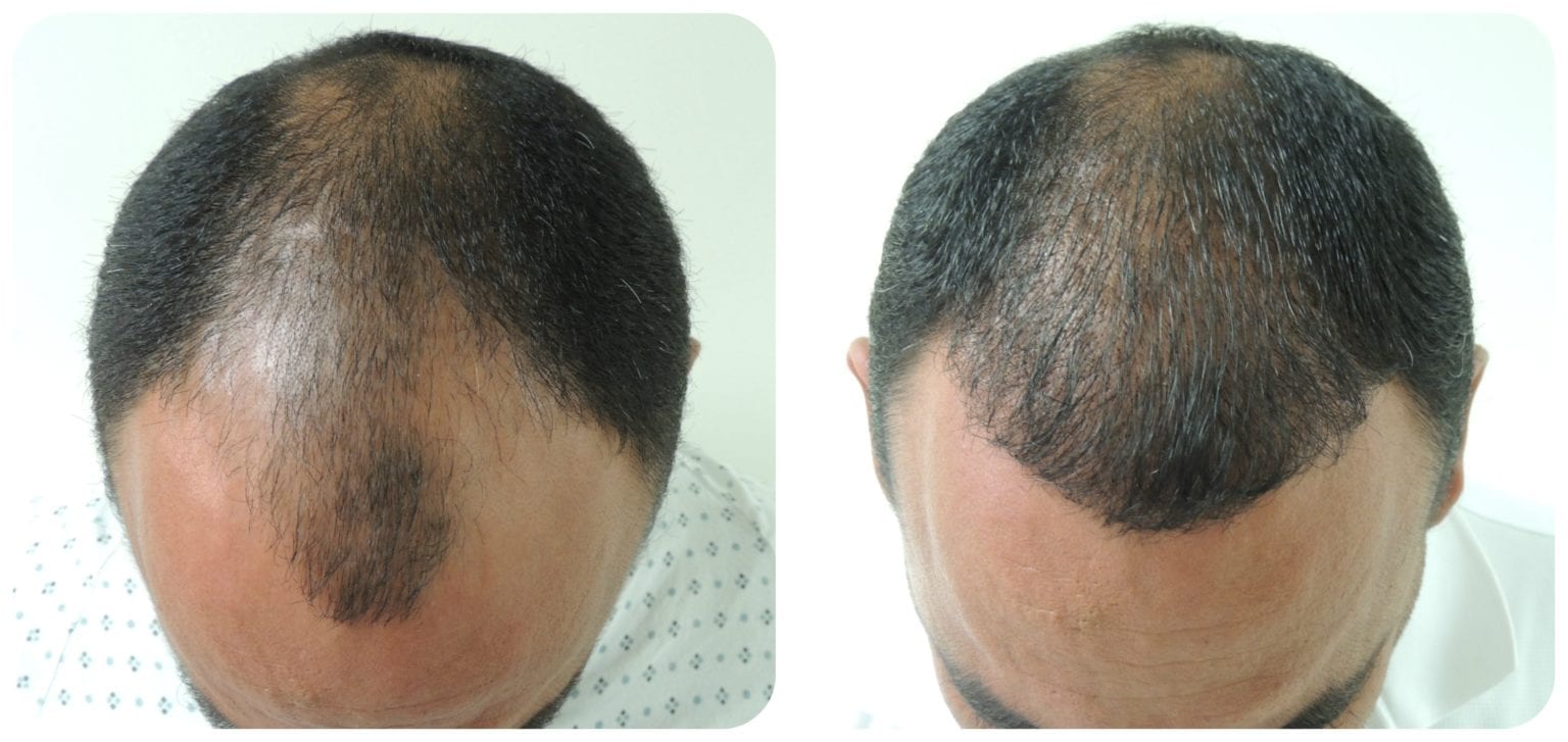 Hair Transplant Types The Complete Guide to All of Your Options