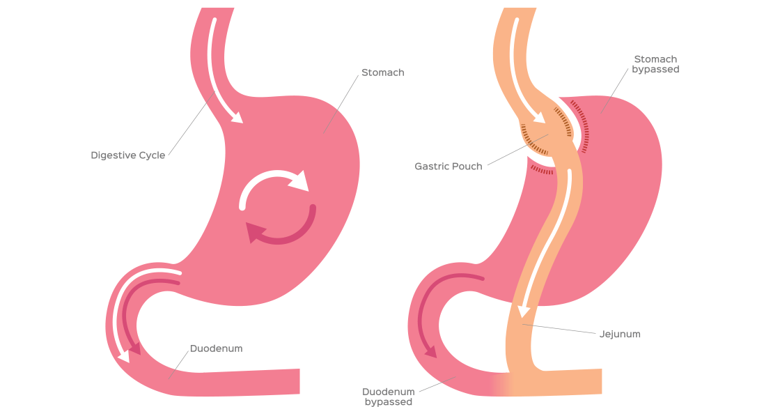 gastric bypass