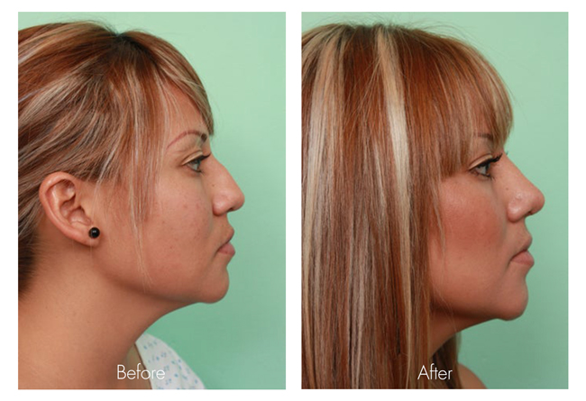 rhinoplasty surgery in mexico