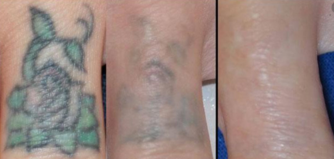 Laser Tattoo Removal - Schweiger Dermatology Group