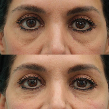 Botox, facial rejuvenation, fillers, skin care, age management, wrinkles, vida clinic, tijuana