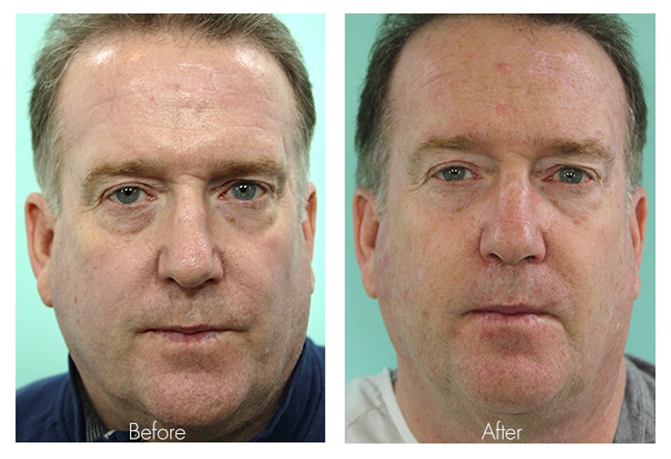 laser skin resurfacing mexico