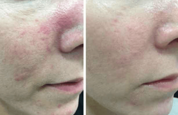 IPL for Rosacea: Everything You Should Know - VIDA Wellness and Beauty