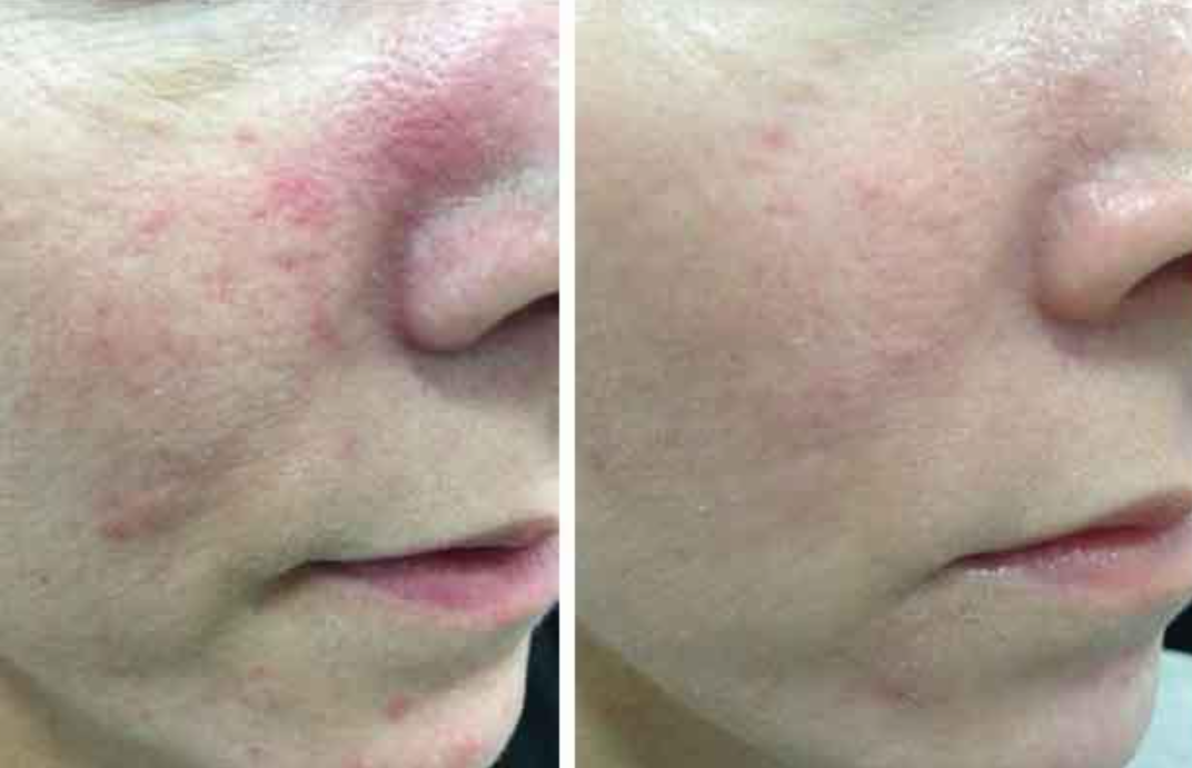 ipl for rosacea