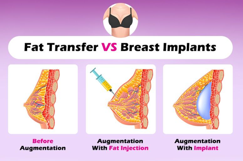Breast Fat Transfer vs Implants: Advantages & Disadvantages
