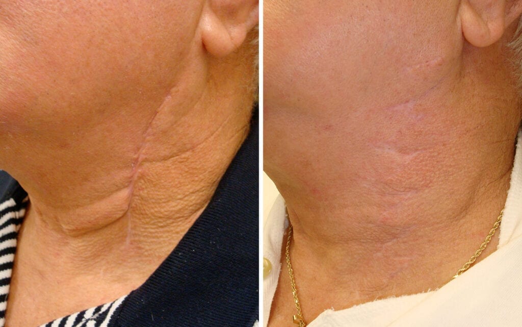 Scar Therapy VIDA Wellness and Beauty
