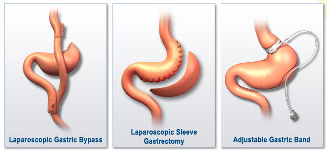 what is bariatric surgery