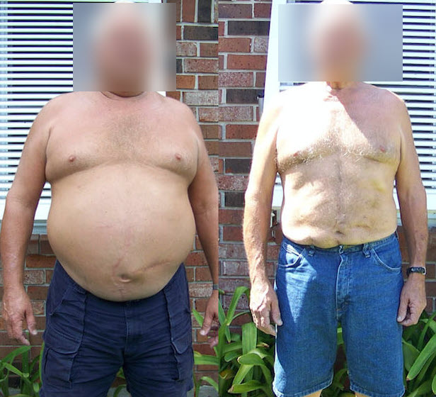 senior elderly bariatric weight loss surgery