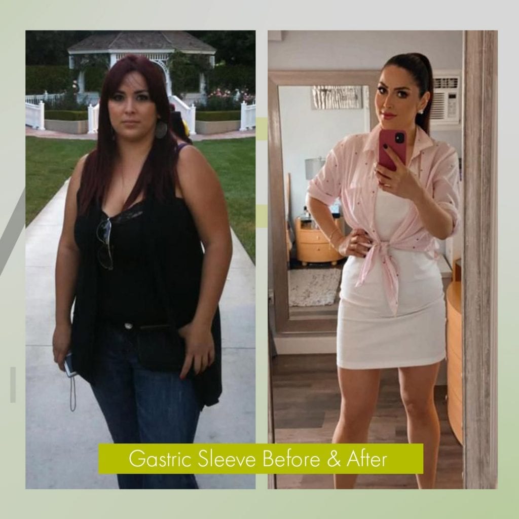 before and after bariatric weight loss