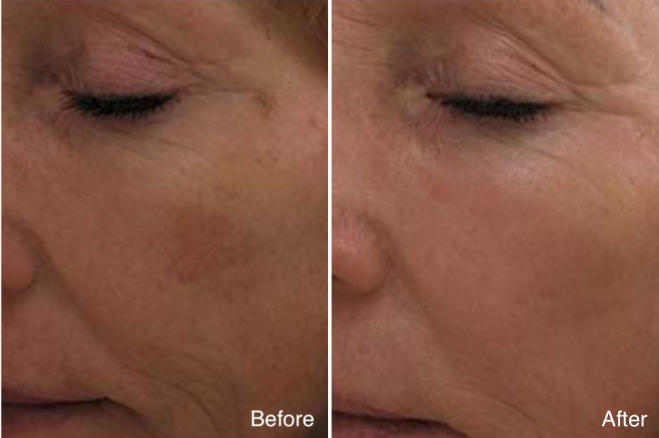 Hyperpigmentation female Patient before and after